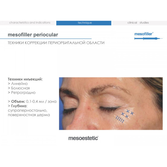 Мезофиллер Периокулар 15 мг/мл Mesoestetic Мesofiller periocular 15 mg/ml шприц 1мл