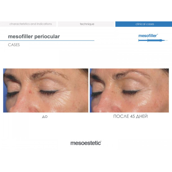 Мезофиллер Периокулар 15 мг/мл Mesoestetic Мesofiller periocular 15 mg/ml шприц 1мл