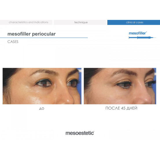 Мезофиллер Периокулар 15 мг/мл Mesoestetic Мesofiller periocular 15 mg/ml шприц 1мл