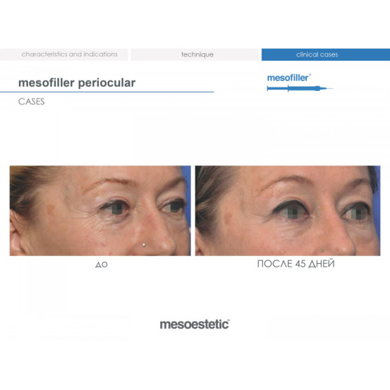 Мезофиллер Периокулар 15 мг/мл Mesoestetic Мesofiller periocular 15 mg/ml шприц 1мл