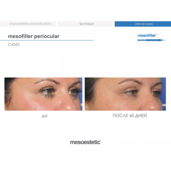 Мезофиллер Периокулар 15 мг/мл Mesoestetic Мesofiller periocular 15 mg/ml шприц 1мл