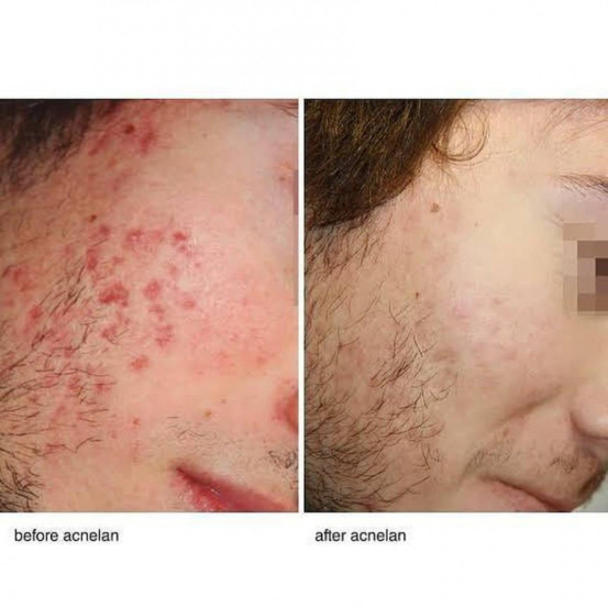 Профессиональный набор для лечения акне "Акневан" Mesoestetic Аcneone pack