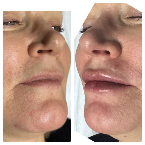 Мезофиллер Глобал 20 мг/мл Mesoestetic Mesofiller global 20 mg/ml шприц 1мл