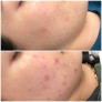 Профессиональный набор для лечения акне "Акневан" Mesoestetic Аcneone pack